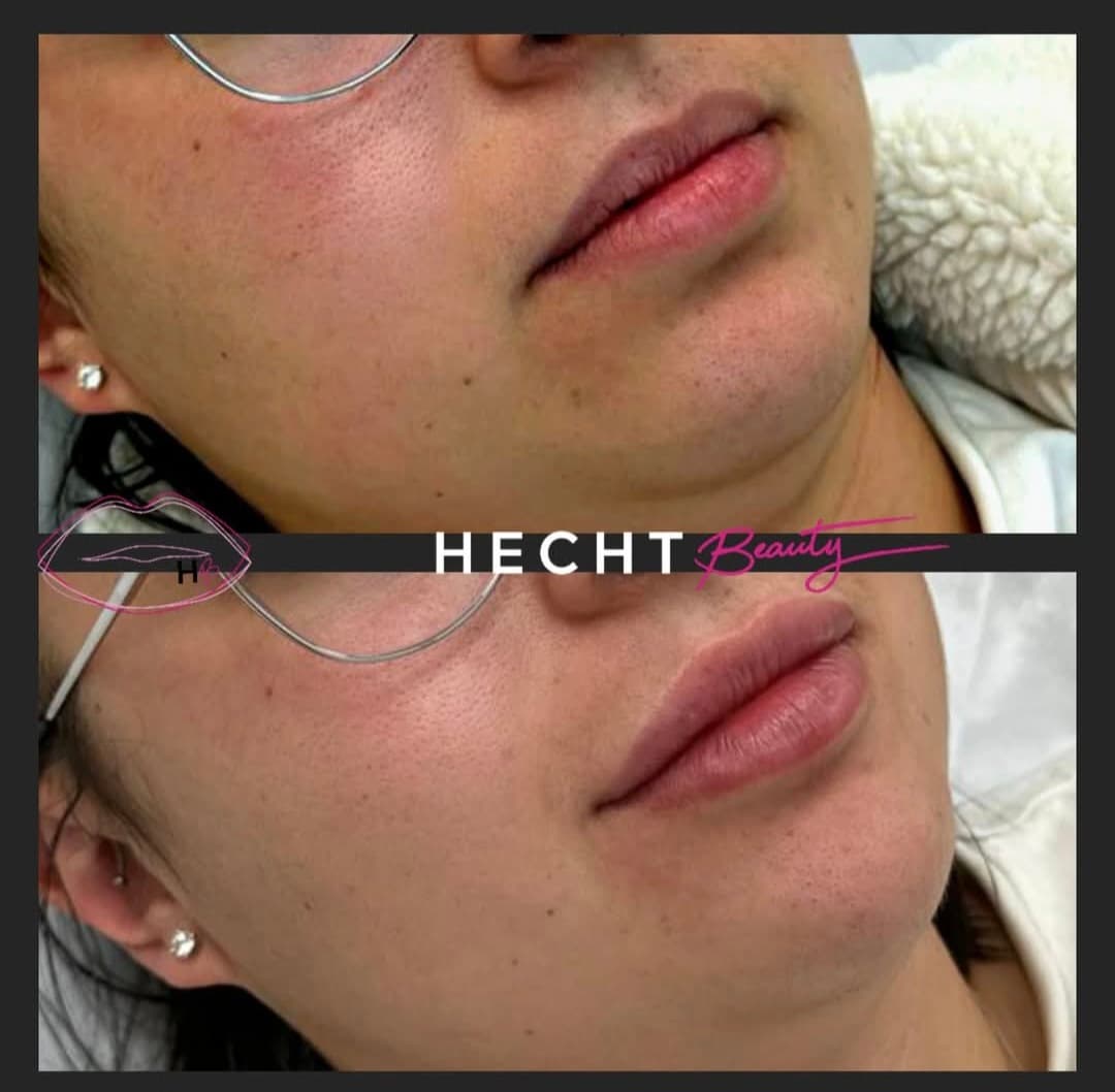 מילוי של חומצה היאלורונית - Image 1